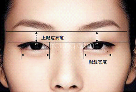 新氧美容App名医荟:欧式大平行双眼皮如何做