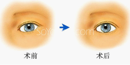 新氧美容App名医荟:欧式大平行双眼皮如何做